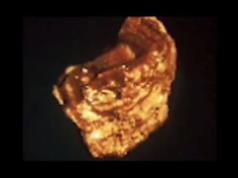 kidney stone