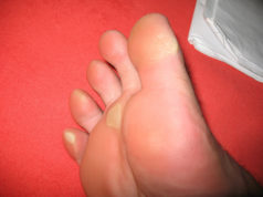 callus