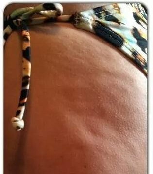 cellulite