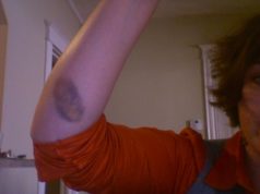 easy bruising