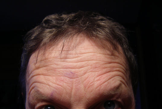 forehead