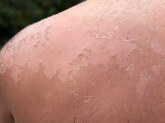 skin cancer