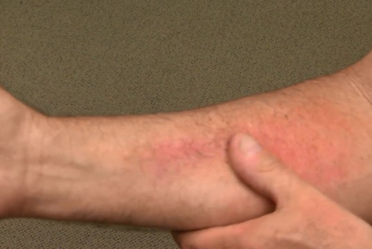 rash