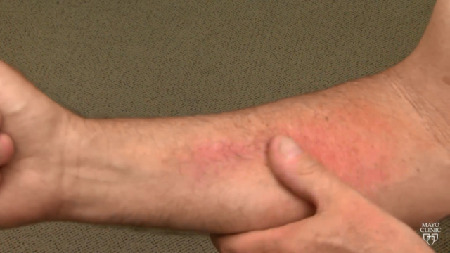 rash