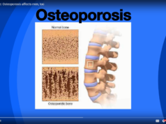 osteoporosis
