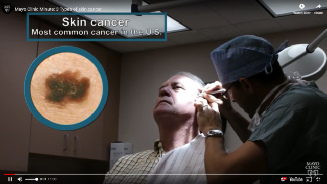 skin cancer