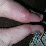 “side-pair gout” by trevg1 is licensed under CC BY-NC 2.0 /MINOLTA DIGITAL CAMERA