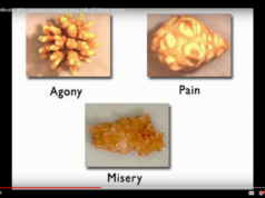 Kidney Stones