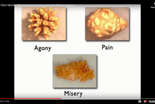 Kidney Stones