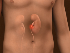 kidney stone