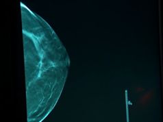 breast
