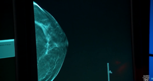 breast