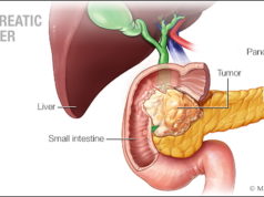Pancreatic Cancer