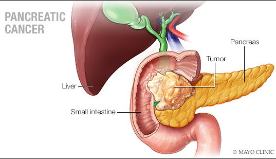 Pancreatic Cancer