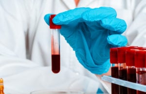 FDA Clears 2 New Alzheimer’s Blood Tests, Including One For Adults As Young As 40 freepik/doctor-s-hands-blue-gloves-keep-test-tube-with-blood_93675-69701