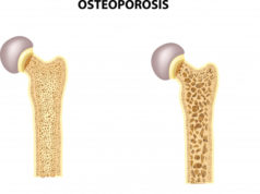 https://www.freepik.com/premium-vector/illustration-bone-hip_2579172.htm#page=1&query=osteoporosis&position=36