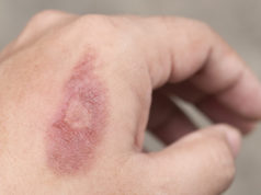 https://www.freepik.com/premium-photo/burned-wound_3334410.htm#page=1&query=burns&position=24