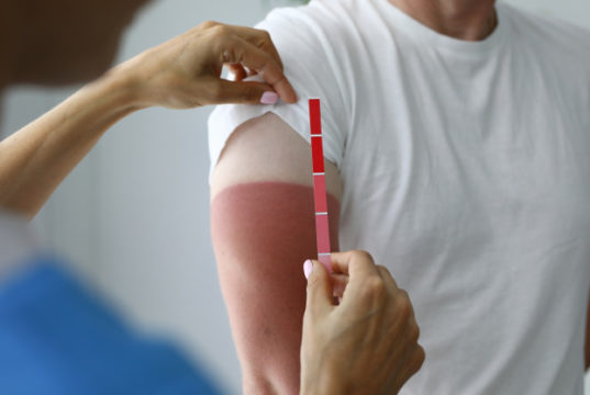 https://www.freepik.com/premium-photo/doctor-determines-degree-sunburn_9528833.htm#page=2&query=sunburn&position=19