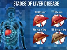 https://www.freepik.com/free-vector/stages-liver-disease_11207715.htm