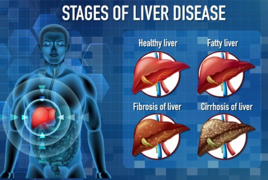 https://www.freepik.com/free-vector/stages-liver-disease_11207715.htm