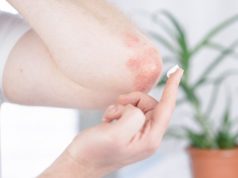 https://www.freepik.com/premium-photo/man-applies-cream-elbow-affected-by-psoriasis_13777117.htm#page=1&query=psoriasis&position=42