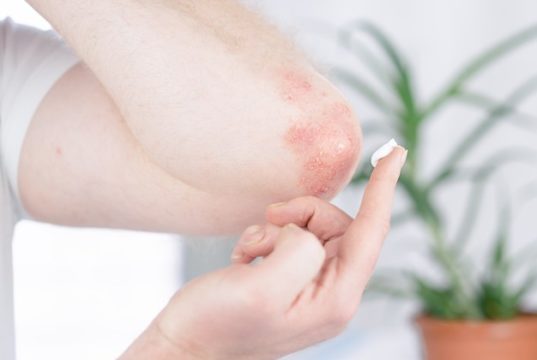 https://www.freepik.com/premium-photo/man-applies-cream-elbow-affected-by-psoriasis_13777117.htm#page=1&query=psoriasis&position=42