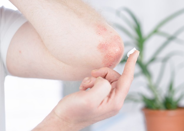 https://www.freepik.com/premium-photo/man-applies-cream-elbow-affected-by-psoriasis_13777117.htm#page=1&query=psoriasis&position=42