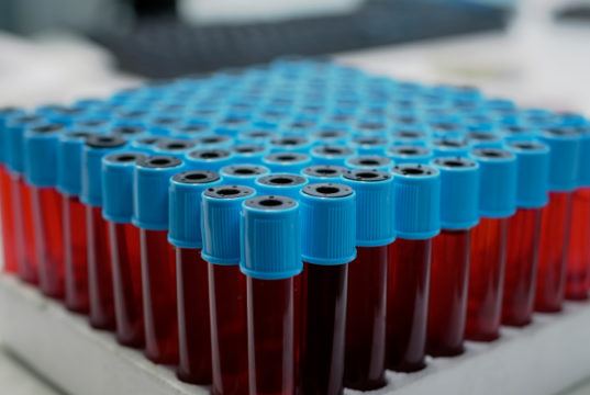 https://www.freepik.com/free-photo/close-up-medical-vacutainers-with-blood-tray_17009862.htm?query=blood%20lab