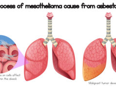 https://www.freepik.com/premium-vector/process-mesothelioma-cause-asbestos_2440347.htm#query=Mesothelioma&position=18&from_view=search