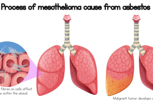 https://www.freepik.com/premium-vector/process-mesothelioma-cause-asbestos_2440347.htm#query=Mesothelioma&position=18&from_view=search