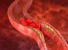 https://www.freepik.com/premium-photo/atherosclerosis-is-accumulation-cholesterol-plaques-walls-arteries_4975251.htm#query=cholesterol&position=8&from_view=search