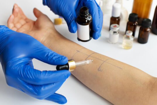 https://www.freepik.com/free-photo/skin-allergy-reaction-test-person-s-arm_19672569.htm#query=food%20allergy&position=10&from_view=search