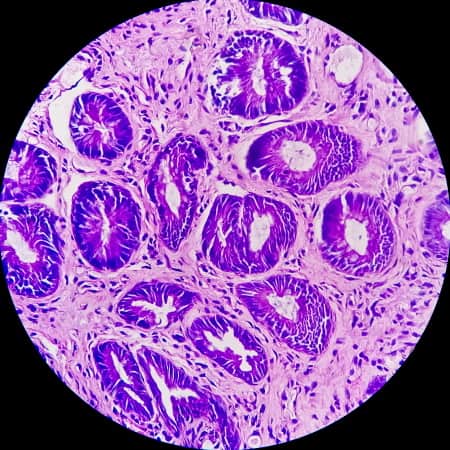 https://www.vecteezy.com/photo/4907286-photomicrograph-of-rectal-cancer-microscopic-slide-view-ibd-ibs-close-up