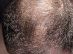 https://www.vecteezy.com/photo/2844601-hair-loss-man-scalp-baldness-closeup