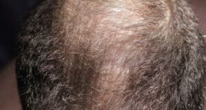 https://www.vecteezy.com/photo/2844601-hair-loss-man-scalp-baldness-closeup