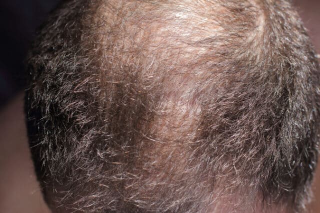 vecteezy_hair-loss-man-scalp-baldness-closeup_2844601 https://www.vecteezy.com/photo/2844601-hair-loss-man-scalp-baldness-closeup
