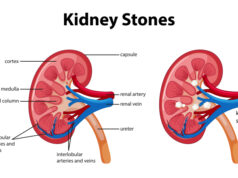 https://www.freepik.com/free-vector/kidney-stones-symptoms-cartoon-style-infographic_10137013.htm#query=kidney%20stone&position=0&from_view=search