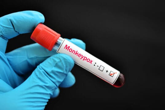 https://www.freepik.com/premium-photo/blood-sample-monkeypox-virus-test-dna-virus-member-poxviridae-family_27310953.htm#query=monkeypox&position=15&from_view=search