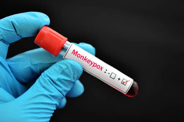 https://www.freepik.com/premium-photo/blood-sample-monkeypox-virus-test-dna-virus-member-poxviridae-family_27310953.htm#query=monkeypox&position=15&from_view=search