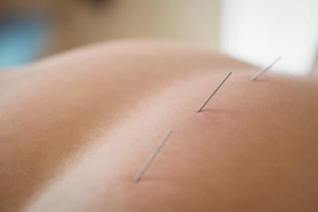 Close-up of a patient getting dry needling on his back https://www.freepik.com/free-photo/close-up-patient-getting-dry-needling_8405510.htm#query=acupuncture&position=44&from_view=search