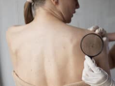 https://www.freepik.com/free-photo/female-doctor-diagnosing-melanoma-body-female-patient_25169044.htm?query=melanoma