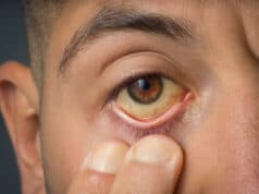 https://www.freepik.com/premium-photo/man-checking-yellow-eyes-high-bilirubin-level-cirrhosis-hepatitis-liver-disease-liver-jaundice_24110538.htm#query=bad%20liver&position=24&from_view=search