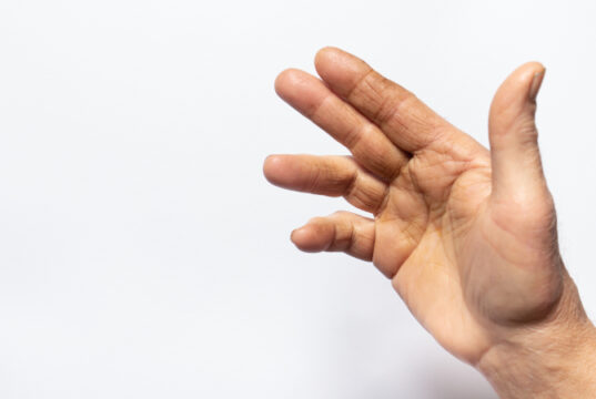 https://www.freepik.com/premium-photo/human-hand-brush-white-background-disease-joint-palm-dupuytren-s-contracture-fingers-bend-medicine-traumatology-orthopedics_25793604.htm#query=Dupuytren%20s&position=0&from_view=search&track=sph