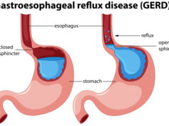 https://www.freepik.com/free-vector/gastroesophageal-reflux-disease-anatomy_2840999.htm#query=GERD&position=44&from_view=search&track=sph