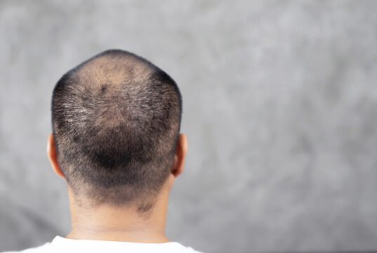 https://www.vecteezy.com/photo/12215805-bald-man-with-hair-problems