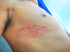 https://www.vecteezy.com/photo/8316022-painful-back-skin-rash-with-blisters-in-a-limited-area-a-man-who-had-varicella-blister-chickenpox-herpes-zoster-or-shingles