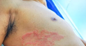 https://www.vecteezy.com/photo/8316022-painful-back-skin-rash-with-blisters-in-a-limited-area-a-man-who-had-varicella-blister-chickenpox-herpes-zoster-or-shingles
