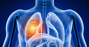 https://www.freepik.com/premium-photo/3d-illustration-human-body-with-lung-pain_6336004.htm#query=lung%20cancer&position=41&from_view=search&track=sph