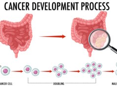 https://www.freepik.com/free-vector/diagram-showing-cancer-development-process_25538781.htm#query=colon%20cancer&position=20&from_view=search&track=ais