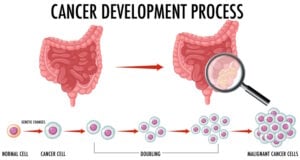 https://www.freepik.com/free-vector/diagram-showing-cancer-development-process_25538781.htm#query=colon%20cancer&position=20&from_view=search&track=ais